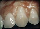 Before Gum Grafting