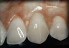 After Gum Grafting