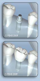 Before and after the crown is placed on the abutment
