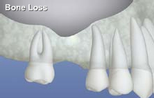 Sinus augmentation illustration