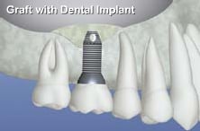 Sinus augmentation illustration with implant