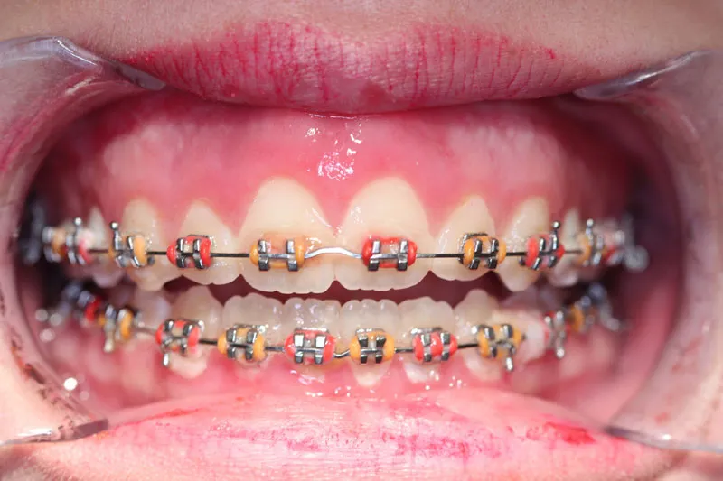 After Crown Lengthening for Orthodontic Treatment