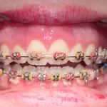 After Crown Lengthening for Orthodontic Treatment