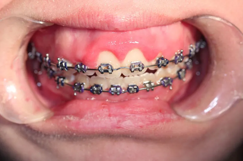 Before Crown Lengthening for Orthodontic Treatment