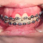Before Crown Lengthening for Orthodontic Treatment