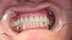 After Crown Lengthening