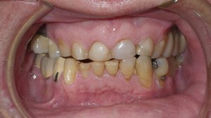 Before Crown Lengthening