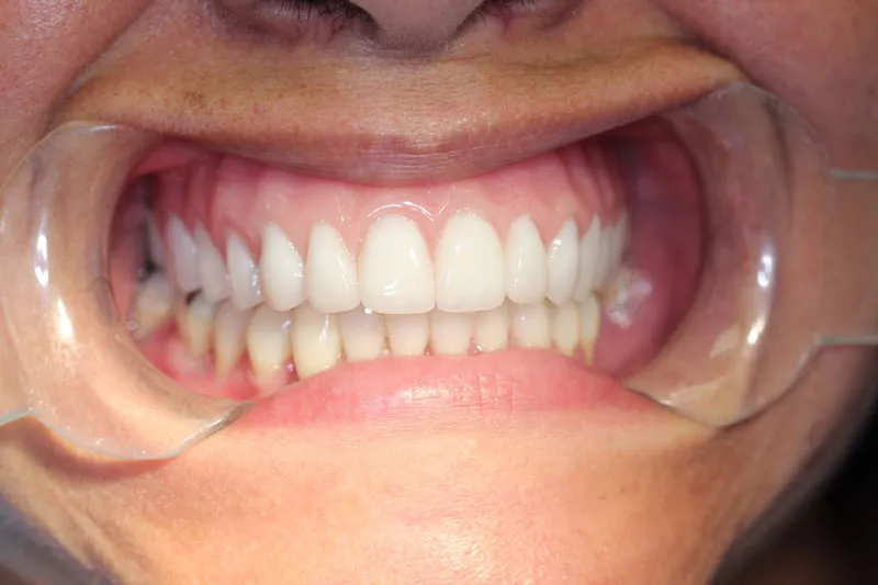 After Full Upper Implant Reconstruction