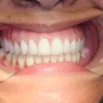 After Full Upper Implant Reconstruction