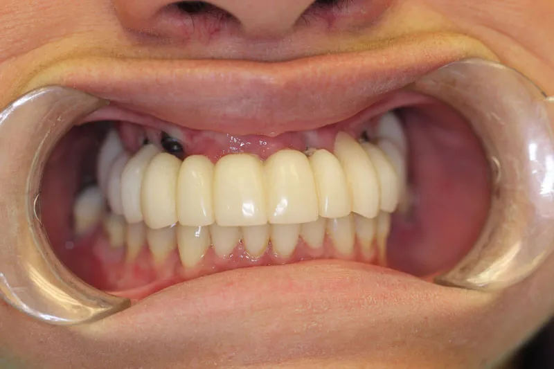Before Full Upper Implant Reconstruction