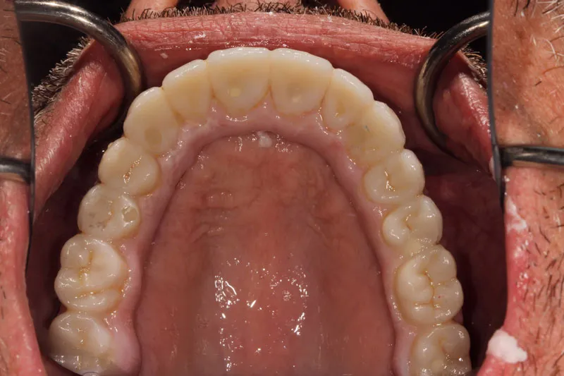 After Full Upper Implant Reconstruction