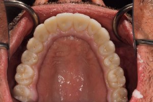 After Full Upper Implant Reconstruction
