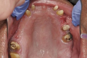 Before Full Upper Implant Reconstruction