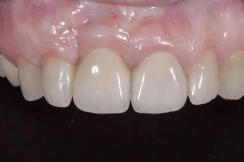 After Gum Grafting