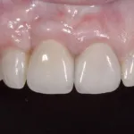 After Gum Grafting