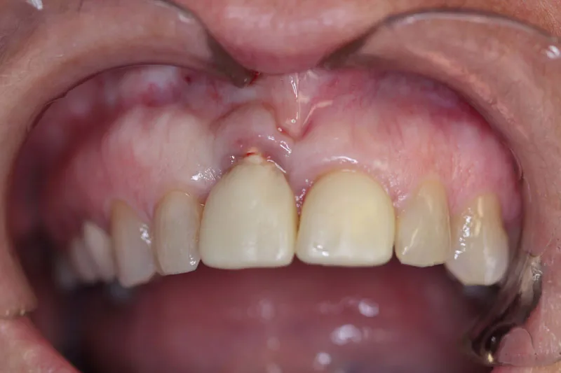 Before Gum Grafting