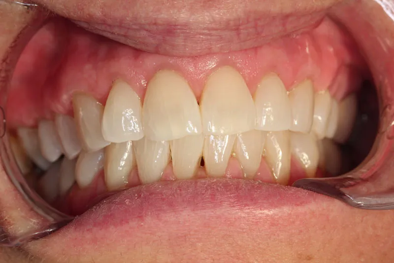 After Gum Grafting