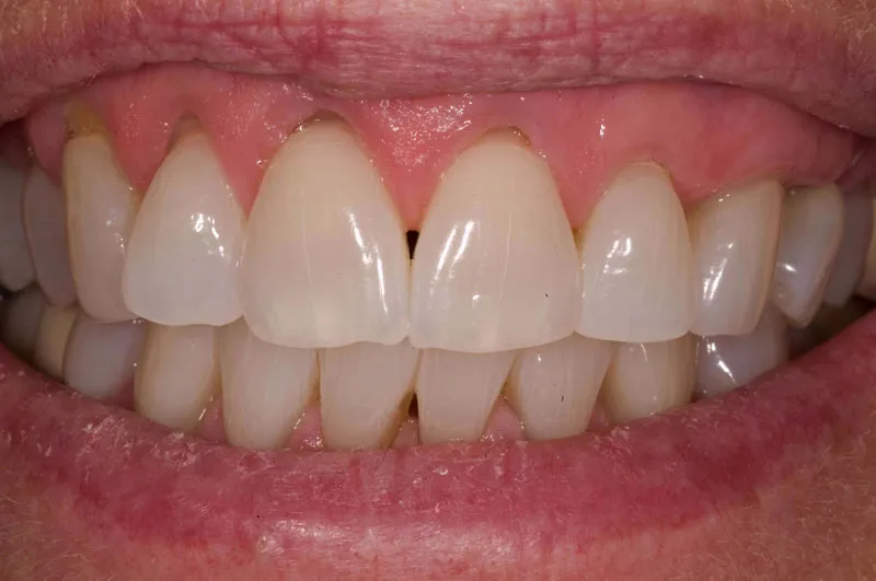 Before Gum Grafting