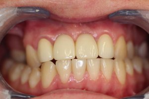 After Individual Front Implants