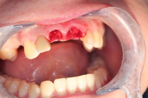 Before Individual Front Implants